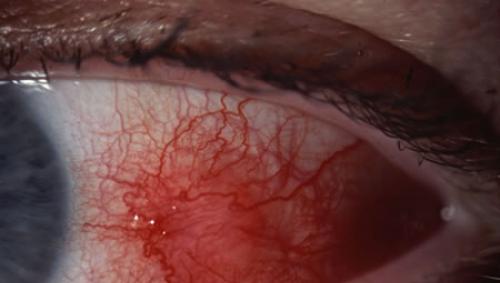 Склерит — серьёзное и опасное заболевание глаз Склеры в норме